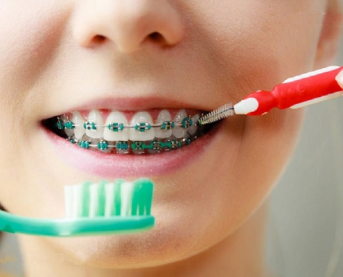 ارتودنسی و لق شدن دندان ها