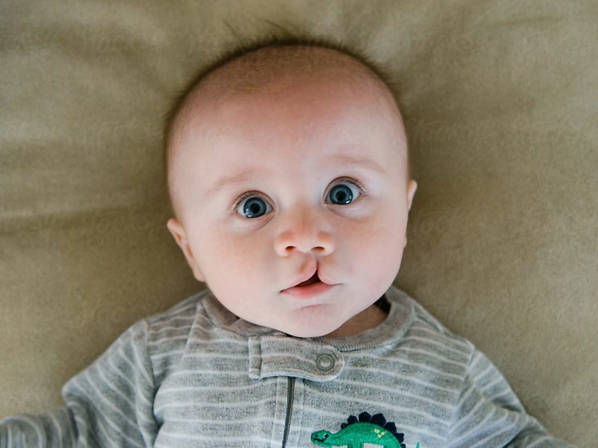 شکاف لب و کام